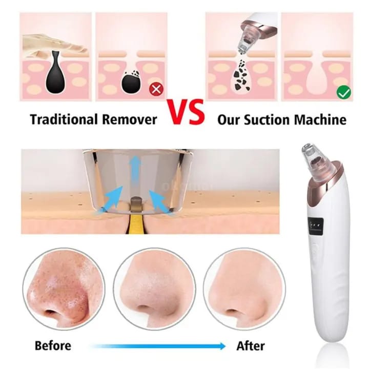 Face Vacuum Suction Blackhead Remover Pore Cleaner | Electric Deep Cleansing Tool for Nose & Face - Image 4